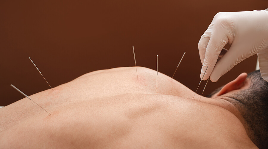Acupuncture Treatment Melbourne